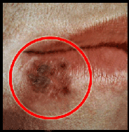 This is the stage that generally has a series of scabs forming and dropping off until skin returns to normal