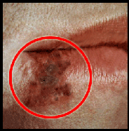 Stage 4 is where the ulcers start to crust over.