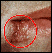 Second Stage Herpes 1 clear blisters