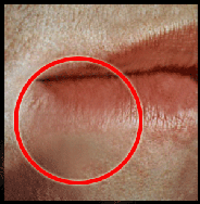 Stage 1 Herpes or the Tingle Stage